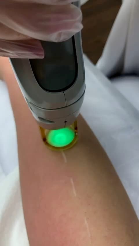 Laser hair removal treatment in progress at Lily Skincare & Laser Clinic in Vienna, VA