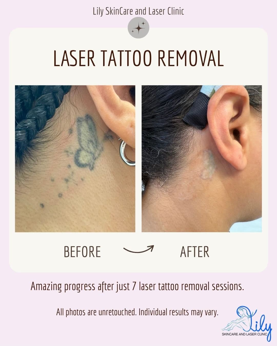 Before and after laser tattoo removal Vienna VA: a butterfly tattoo behind the ear significantly faded after 7 sessions at Lily Skincare & Laser Clinic