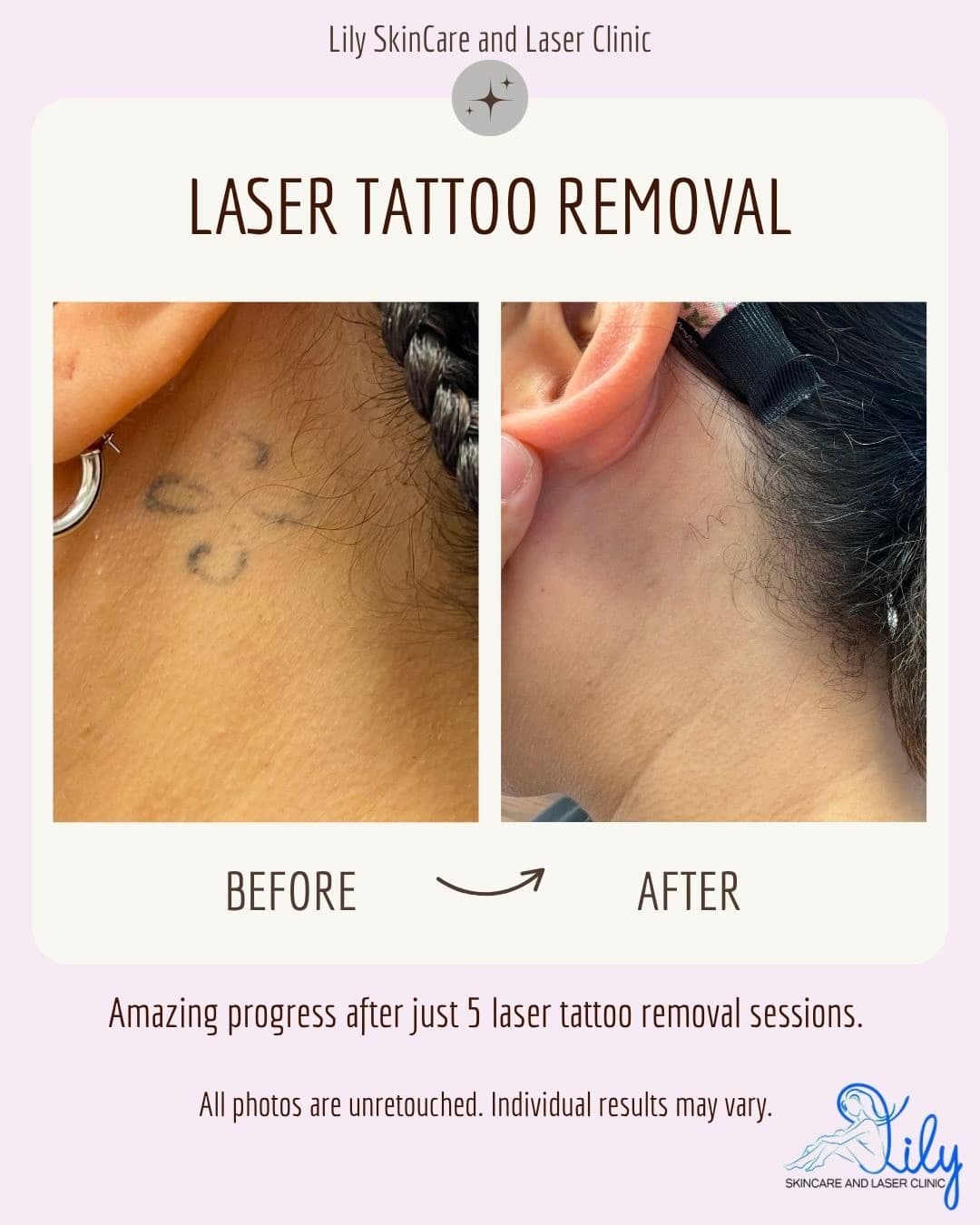 Before and after laser tattoo removal Vienna VA: a small neck tattoo faded to a faint trace after 5 sessions at Lily Skincare & Laser Clinic