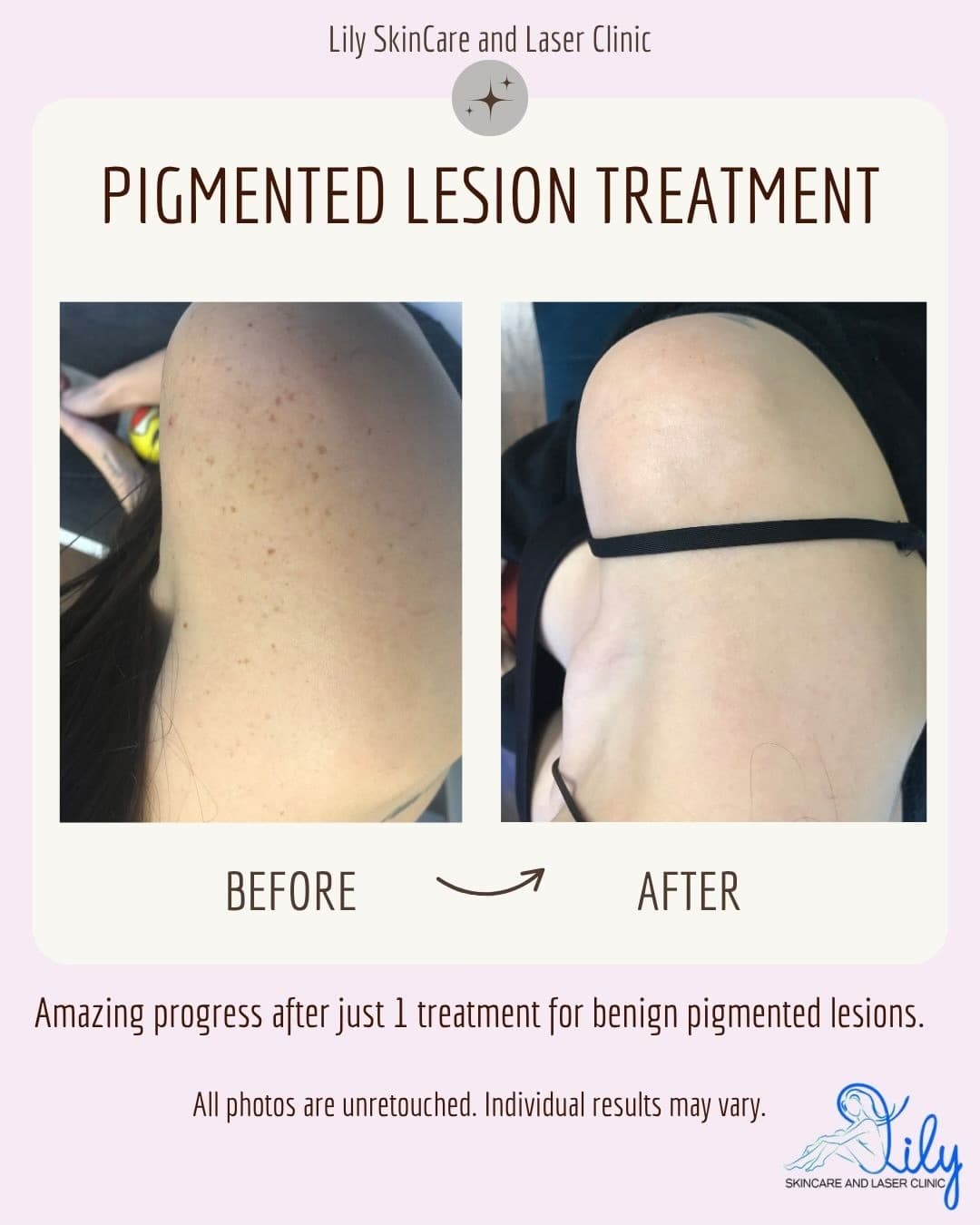 Before and after pigmented lesion treatment in Vienna VA: sun spots and freckles on the shoulder cleared after 1 treatment at Lily Skincare & Laser Clinic